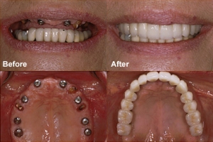 dental implants London